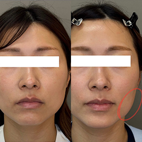 ボトックス症例01