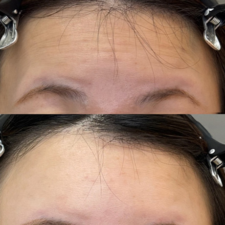 ボトックス症例02