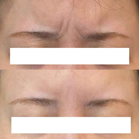 ボトックス症例03