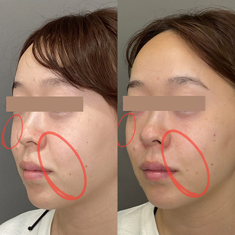 ヒアルロン酸症例