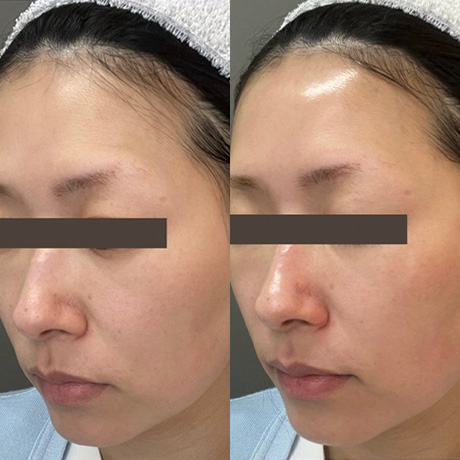 PQAgeピーリング