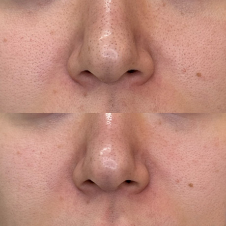 サーマニードル症例