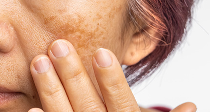 赤み・薄いシミにも効果的