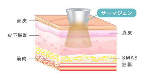 サーマジェンの図解